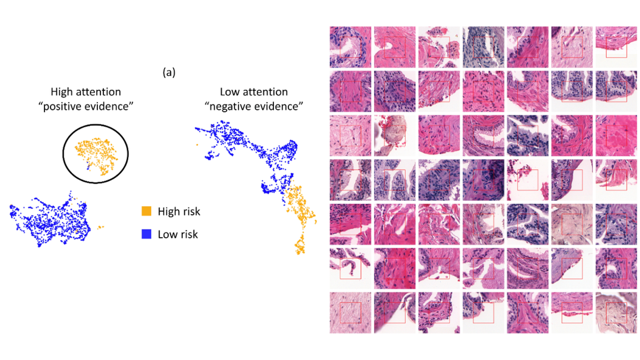 Left: image tiles from prostate biopsies plotted by their learned features, coloured high risk and low risk, separating high-attention “positive evidence” from low-attention “negative evidence”. Right: a grid of hematoxylin-eosin stained tissue tiles.