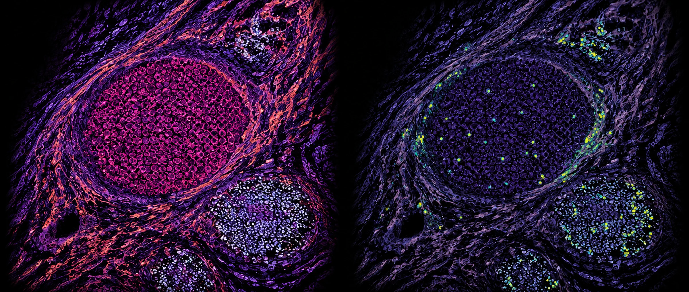 Fluorescence microscopy of a tissue section, shown twice side by side: the left panel in magenta and orange renders the cell membranes and the fibrous sheaths wrapping three densely packed lobes, the right panel renders the same field in violet with scattered yellow and green cells marking a separate signal inside and around them.