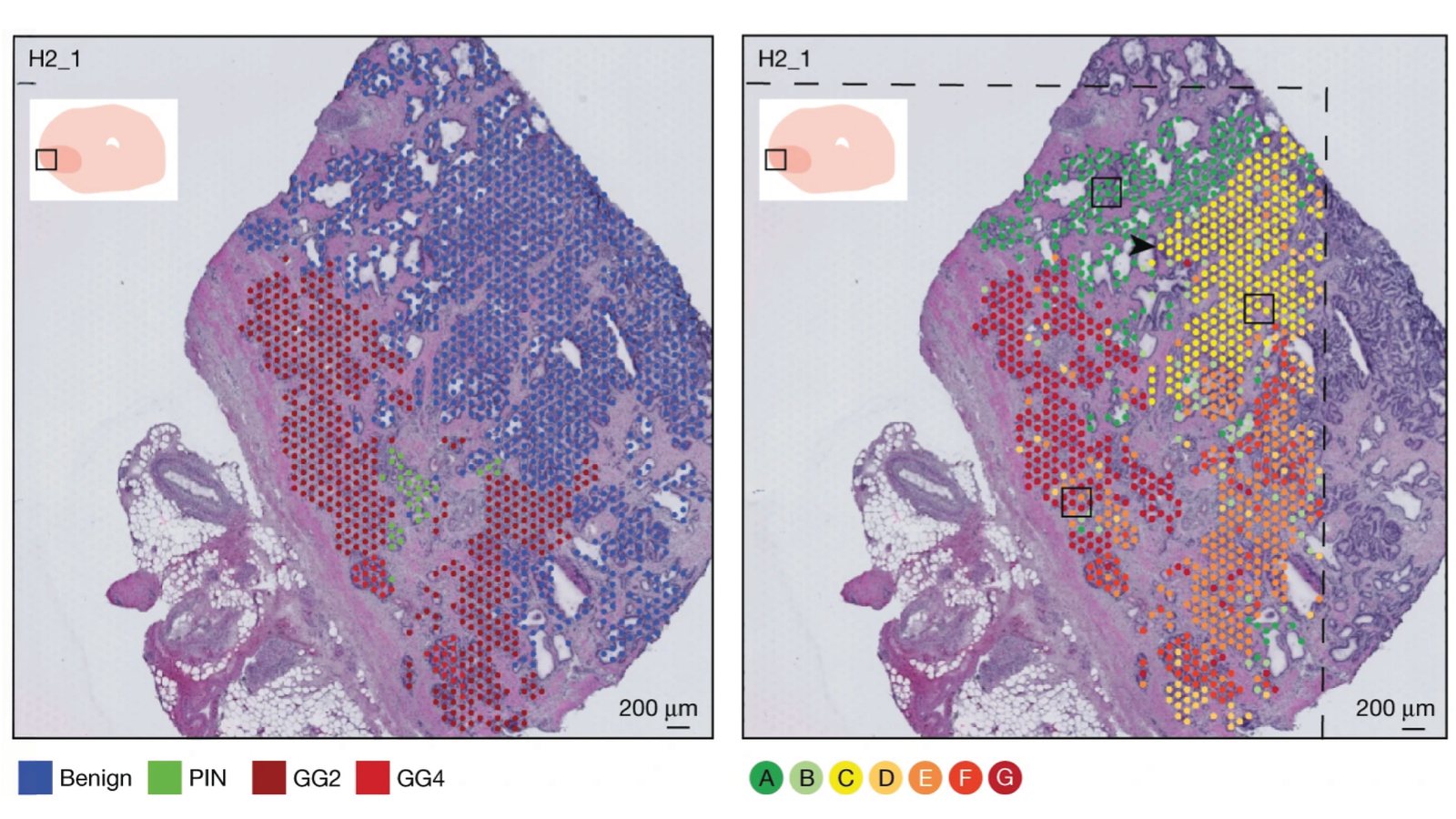 Two views of the same prostate cancer section: spots coloured by pathology, from benign glands to Gleason grade groups 2 and 4, and by inferred copy-number clones.