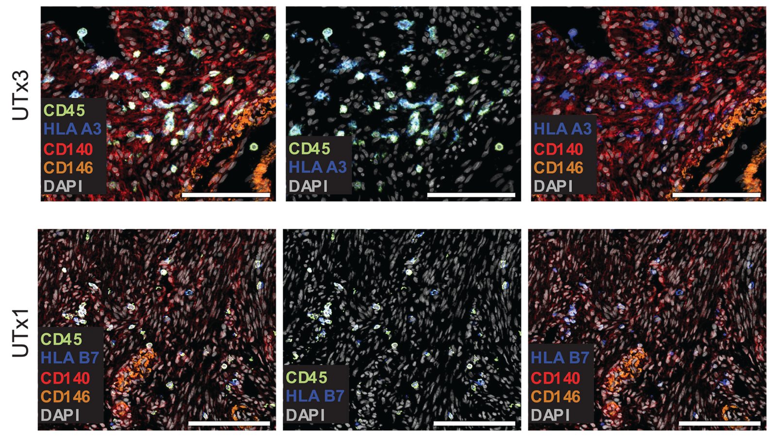 Immunofluorescence of transplanted uterine tissue from two recipients, staining immune cells (CD45) together with an HLA type that tells donor and recipient cells apart, stromal and vascular markers (CD140, CD146) and nuclei.
