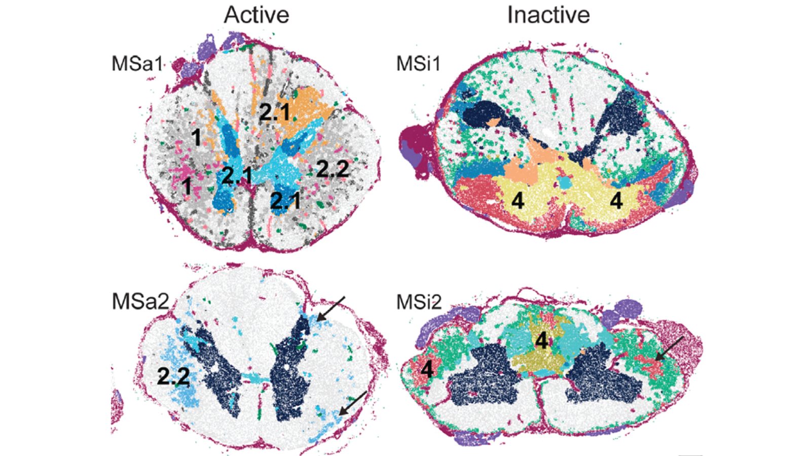 Spinal cord cross-sections labelled as active and inactive multiple sclerosis lesions, with spatially mapped cell clusters coloured and numbered across each section.