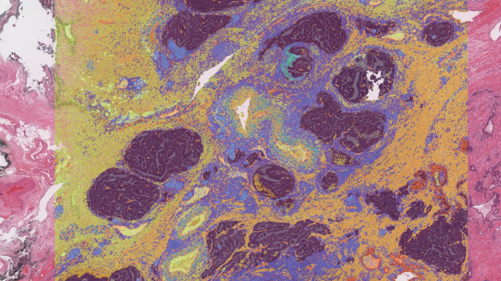 An H&E-stained tissue section with a spatial transcriptomics map overlaid on its centre, colouring distinct tissue regions.